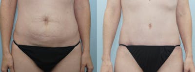 Tummy Tuck Before & After Gallery - Patient 49150787 - Image 1