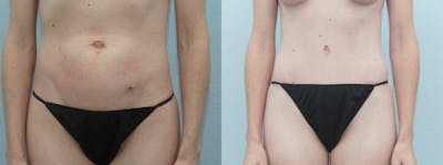 Tummy Tuck Before & After Gallery - Patient 49150799 - Image 1