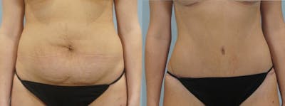 Tummy Tuck Before & After Gallery - Patient 49150800 - Image 1