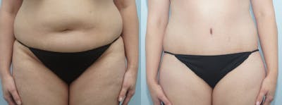 Tummy Tuck Before & After Gallery - Patient 49150804 - Image 1