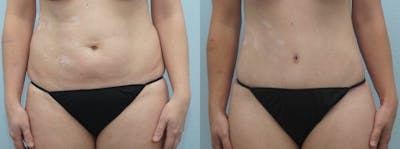 Tummy Tuck Before & After Gallery - Patient 49150805 - Image 1