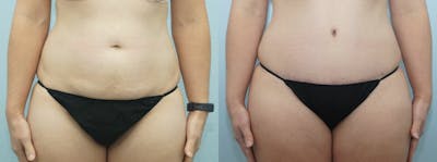 Tummy Tuck Before & After Gallery - Patient 49150807 - Image 1