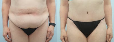Tummy Tuck Before & After Gallery - Patient 49150808 - Image 1