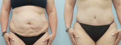 Tummy Tuck Before & After Gallery - Patient 49150809 - Image 1