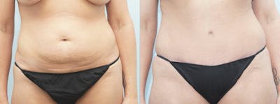 Tummy Tuck Before & After Gallery - Patient 49150811 - Image 1