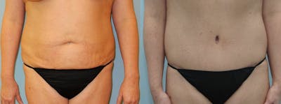 Tummy Tuck Gallery - Patient 49150814 - Image 1