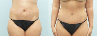 Tummy Tuck Gallery - Patient 49150816 - Image 1