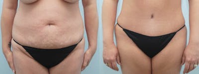 Tummy Tuck Gallery - Patient 49150818 - Image 1