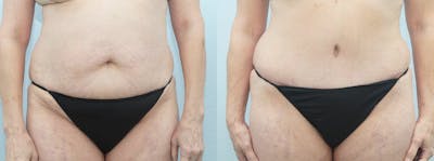Tummy Tuck Gallery - Patient 49150821 - Image 1