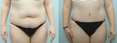 Tummy Tuck Gallery - Patient 49151502 - Image 1