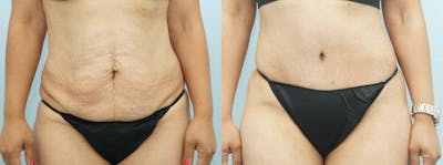 Tummy Tuck Gallery - Patient 49151504 - Image 1