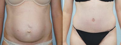 Tummy Tuck Gallery - Patient 49151505 - Image 1