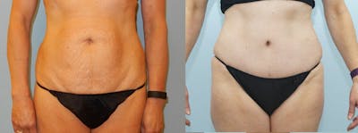 Tummy Tuck Gallery - Patient 49151506 - Image 1