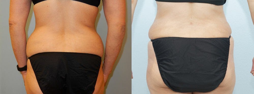 Tummy Tuck Gallery - Patient 49151506 - Image 2