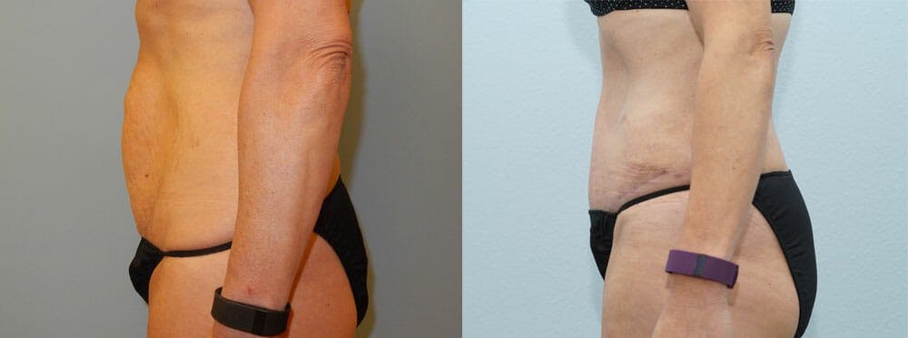 Tummy Tuck Gallery - Patient 49151506 - Image 3