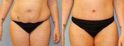 Tummy Tuck Gallery - Patient 49151507 - Image 1