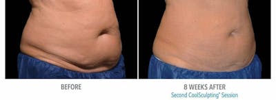 Coolsculpting Before & After Gallery - Patient 47432458 - Image 1