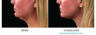 Coolsculpting Before & After Gallery - Patient 47432459 - Image 1