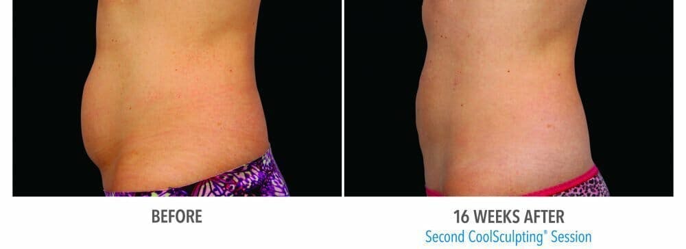 Coolsculpting Gallery - Patient 47432460 - Image 1