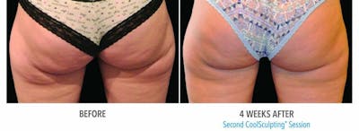 Coolsculpting Before & After Gallery - Patient 47432461 - Image 1