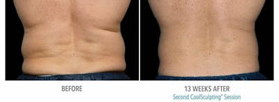 Coolsculpting Before & After Gallery - Patient 47432467 - Image 1