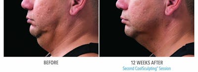 Coolsculpting Before & After Gallery - Patient 47432468 - Image 1
