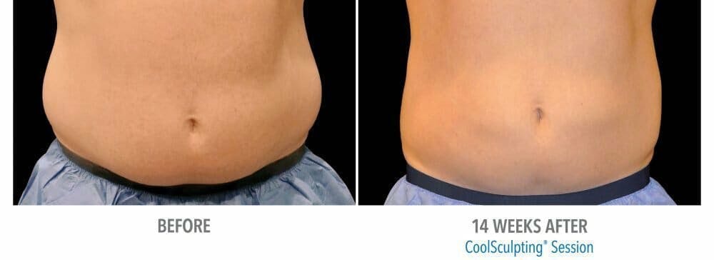 Coolsculpting Gallery - Patient 47432469 - Image 1