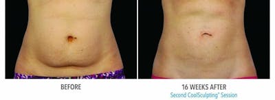 Coolsculpting Before & After Gallery - Patient 47432470 - Image 1
