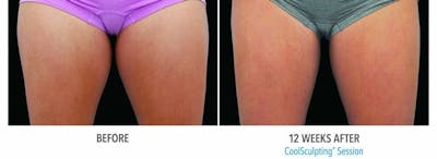 Coolsculpting Before & After Gallery - Patient 47432478 - Image 1