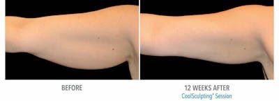 Coolsculpting Before & After Gallery - Patient 47432493 - Image 1