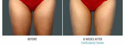 Coolsculpting Before & After Gallery - Patient 47432506 - Image 1