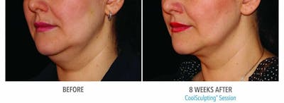 Coolsculpting Before & After Gallery - Patient 47432524 - Image 1