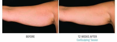 Coolsculpting Before & After Gallery - Patient 47432532 - Image 1