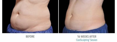 Coolsculpting Before & After Gallery - Patient 47432543 - Image 1