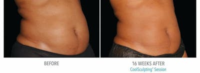 Coolsculpting Before & After Gallery - Patient 53599671 - Image 1