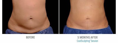 Coolsculpting Before & After Gallery - Patient 53599673 - Image 1