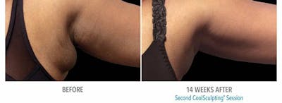 Coolsculpting Before & After Gallery - Patient 47432589 - Image 1