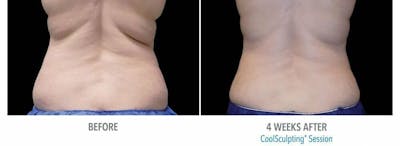 Coolsculpting Before & After Gallery - Patient 53599675 - Image 1