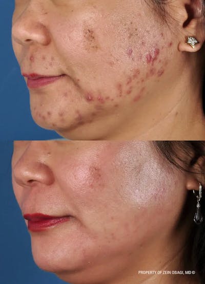 Skin Care Before & After Gallery - Patient 49268455 - Image 1