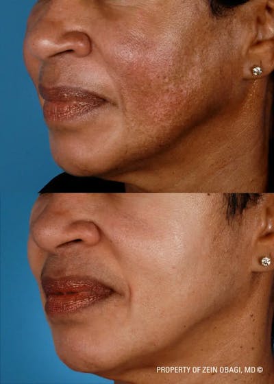 Skin Care Before & After Gallery - Patient 49268456 - Image 1