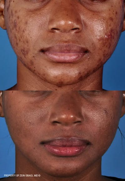 Skin Care Before & After Gallery - Patient 49268457 - Image 1