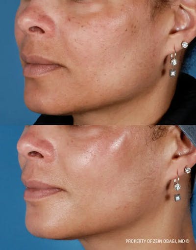 Skin Care Before & After Gallery - Patient 49268458 - Image 1