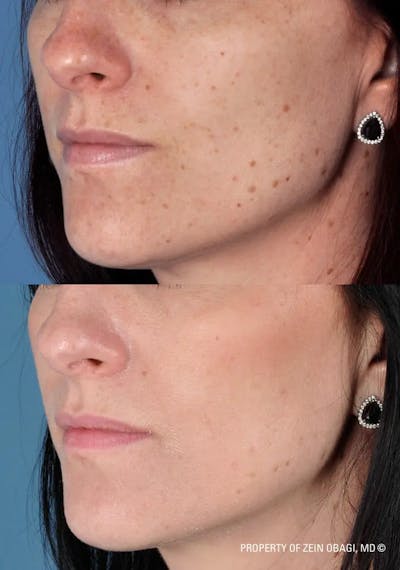 Skin Care Before & After Gallery - Patient 49268459 - Image 1
