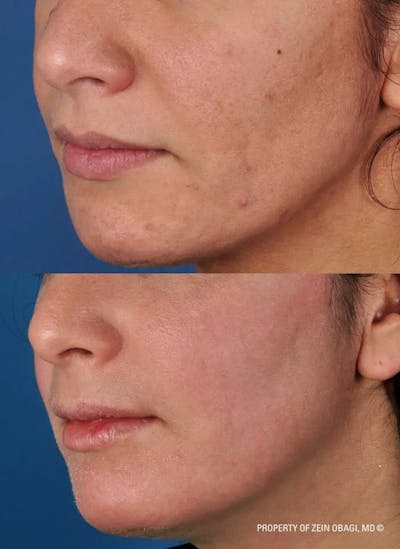 Skin Care Before & After Gallery - Patient 49268460 - Image 1