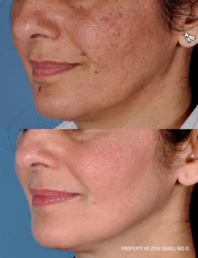Skin Care Before & After Gallery - Patient 49268462 - Image 1
