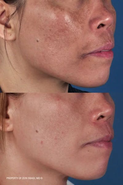 Skin Care Before & After Gallery - Patient 49268463 - Image 1