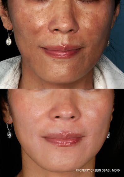 Skin Care Before & After Gallery - Patient 49268464 - Image 1