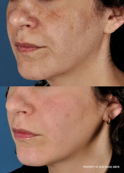 Skin Care Before & After Gallery - Patient 49268465 - Image 1
