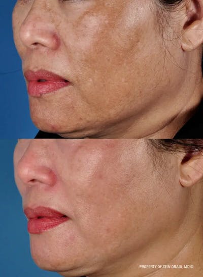 Skin Care Before & After Gallery - Patient 49268466 - Image 1