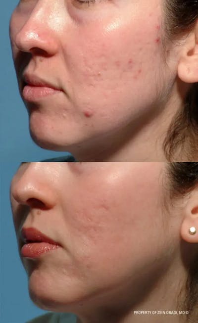 Skin Care Before & After Gallery - Patient 49268467 - Image 1